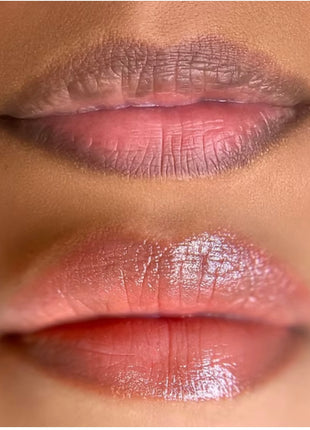 Lip Pigmentation Treatment