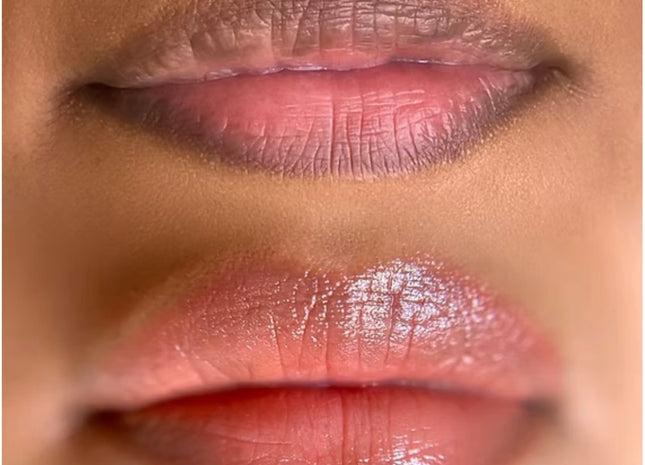 Lip Pigmentation Treatment