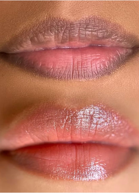 Lip Pigmentation Treatment